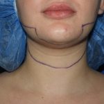 Chin Before & After Patient #3672