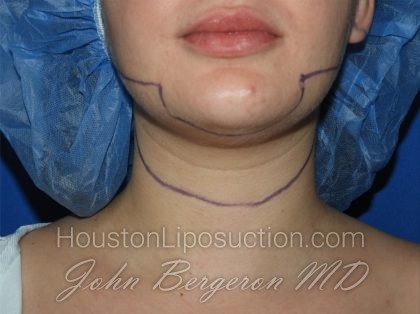 Chin Before & After Patient #3672