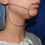 Chin Before & After Patient #3669