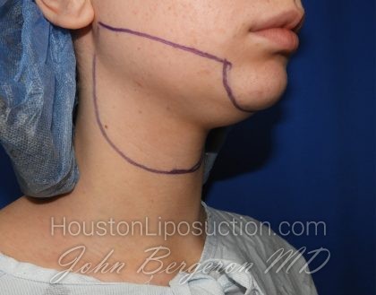 Chin Before & After Patient #3669