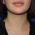 Chin Before & After Patient #3672