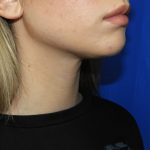 Chin Before & After Patient #3669
