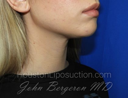 Chin Before & After Patient #3669