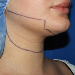 Chin Before & After Patient #3672