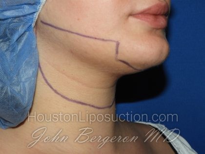 Chin Before & After Patient #3672