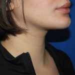 Chin Before & After Patient #3672