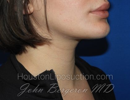 Chin Before & After Patient #3672