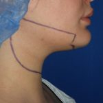 Chin Before & After Patient #3672