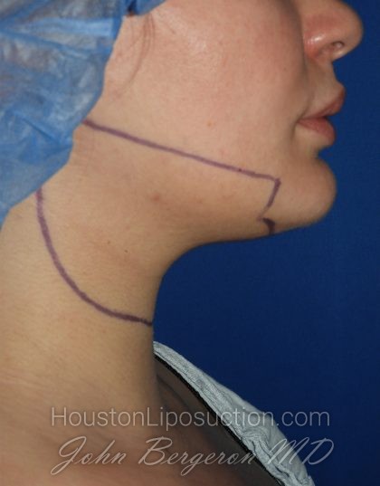 Chin Before & After Patient #3672