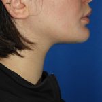 Chin Before & After Patient #3672