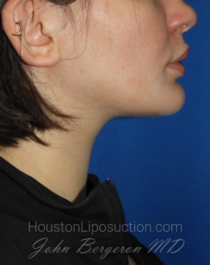 Chin Before & After Patient #3672