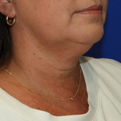 Chin Before & After Patient #3686