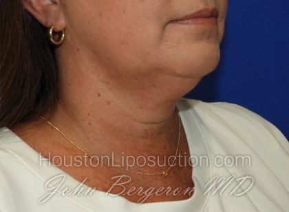 Chin Before & After Patient #3686