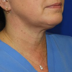 Chin Before & After Patient #3686