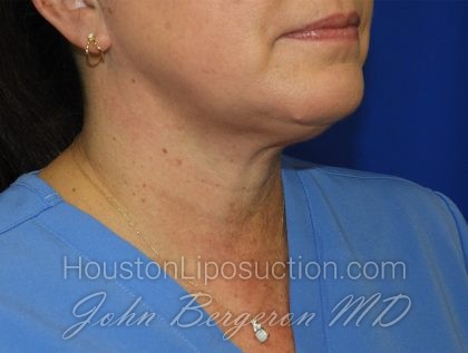 Chin Before & After Patient #3686