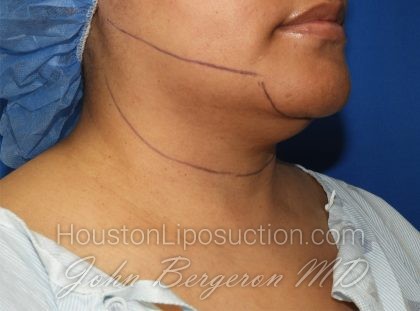 Chin Before & After Patient #3699