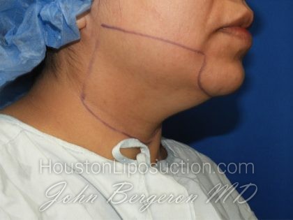 Chin Before & After Patient #3716