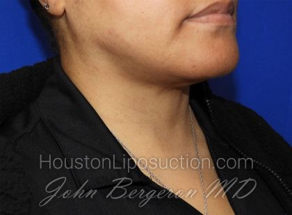 Chin Before & After Patient #3699