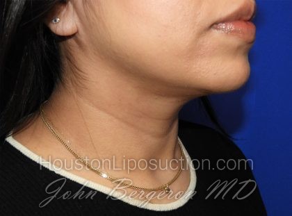 Chin Before & After Patient #3716