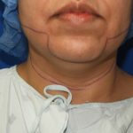 Chin Before & After Patient #3716