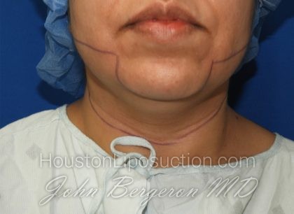Chin Before & After Patient #3716