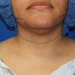 Chin Before & After Patient #3699