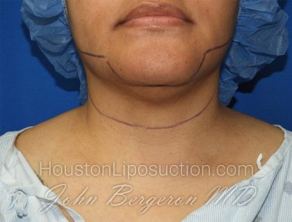 Chin Before & After Patient #3699