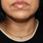 Chin Before & After Patient #3716