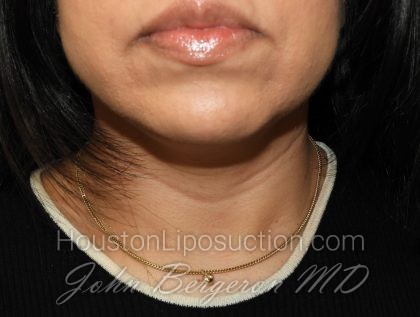Chin Before & After Patient #3716