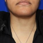 Chin Before & After Patient #3699