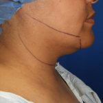 Chin Before & After Patient #3699