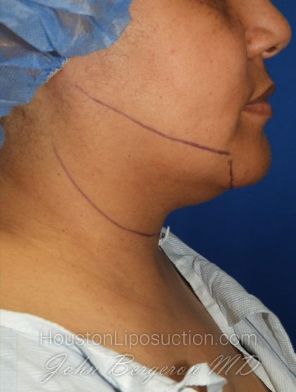 Chin Before & After Patient #3699