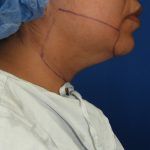 Chin Before & After Patient #3716