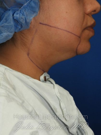 Chin Before & After Patient #3716