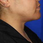 Chin Before & After Patient #3699