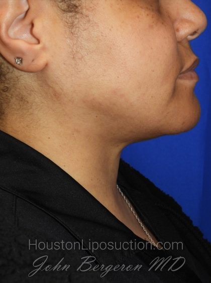 Chin Before & After Patient #3699