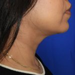 Chin Before & After Patient #3716