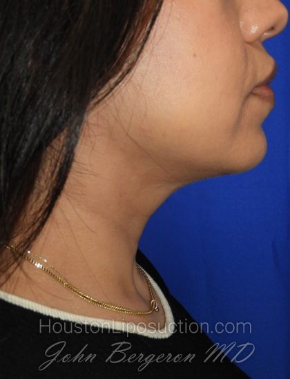 Chin Before & After Patient #3716