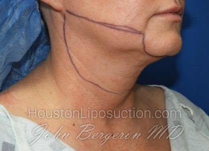 Chin Before & After Patient #3738