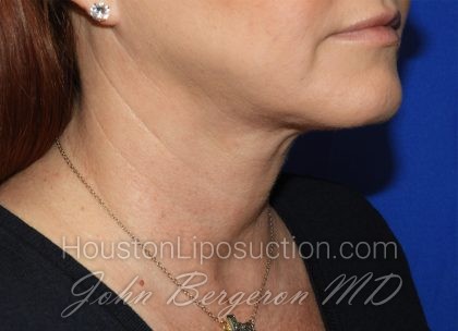 Chin Before & After Patient #3738